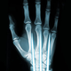 Illustration for article titled Titanium foam could make your bones as strong as Wolverines